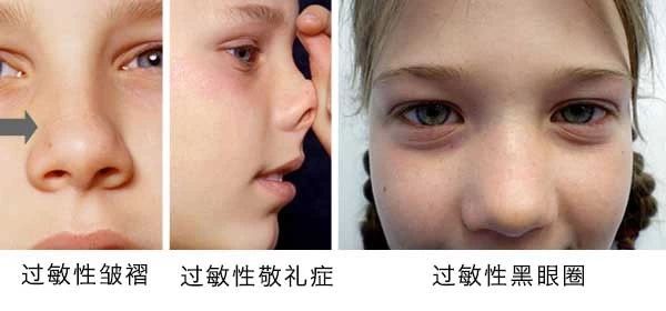 過敏性鼻炎會(huì)讓孩子變傻？！家長該如何應(yīng)對(duì)